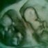 IM HAVING TWIN ...I MISS U ANT..